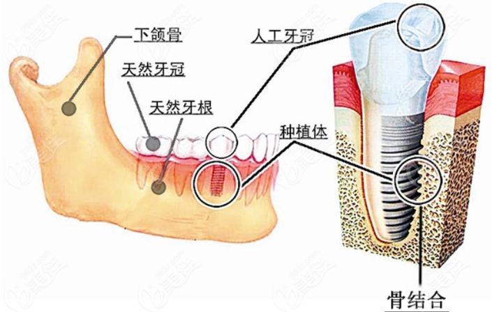 广州深圳瑞士ITI种植牙 牙槽骨条件要求详解