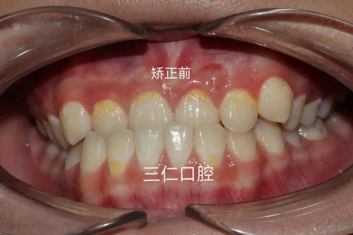 广州种一颗牙矫正价格是多少 看完这篇心里有数