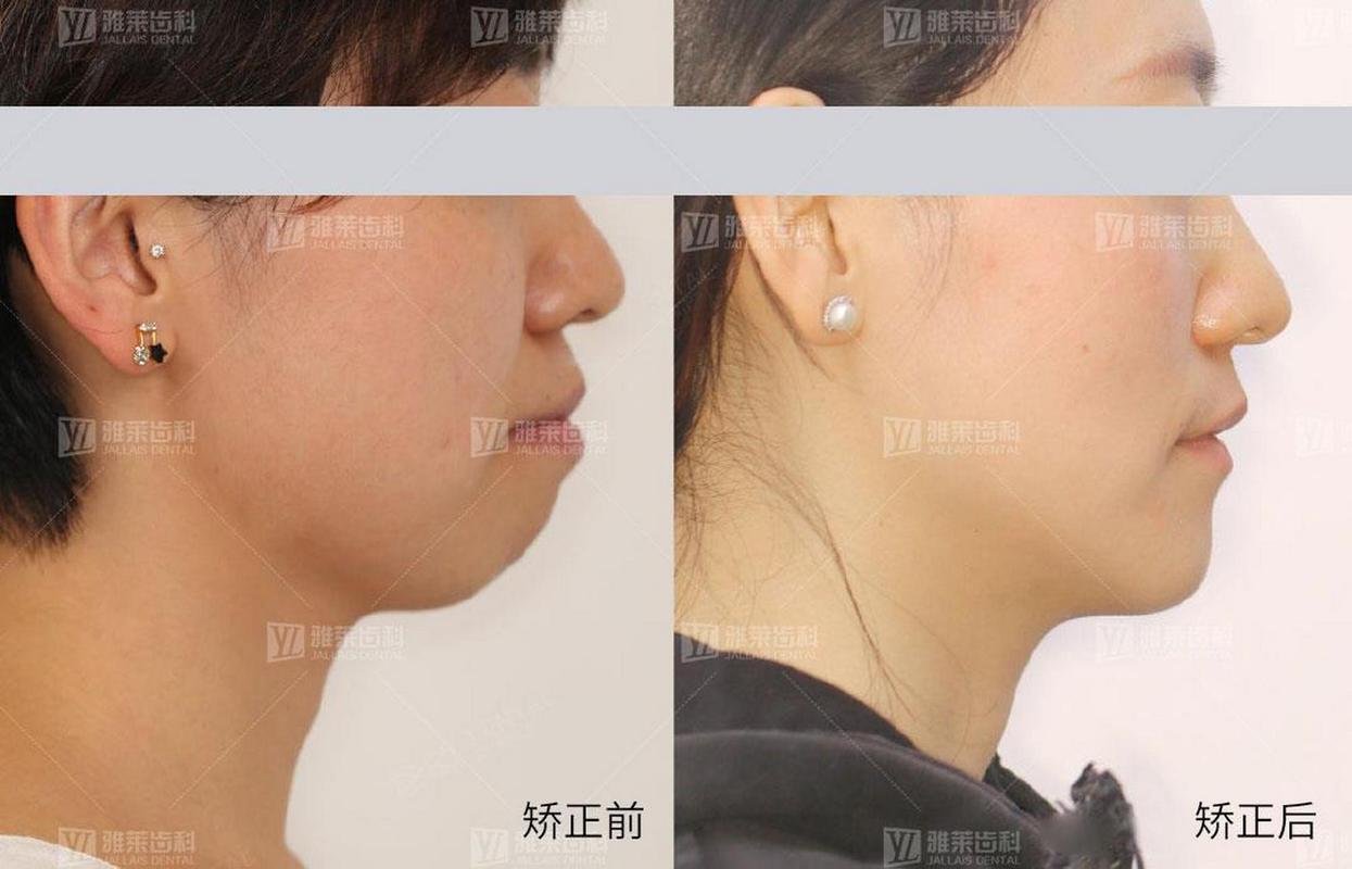 广州矫正牙齿对脸型的改变到底有多大?真实对比告诉你