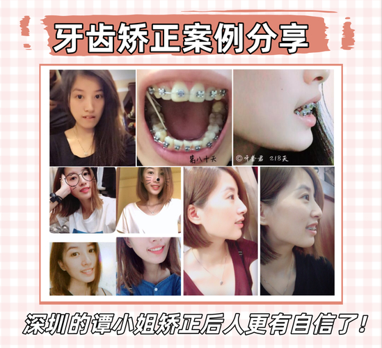 广州深圳福田成人地包天正畸医院怎么选?看完这篇不踩坑