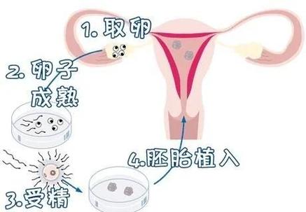 广州无精症试管流程及费用到底怎么算？一篇讲明白