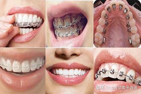 广州34岁做牙齿矫正还来得及吗