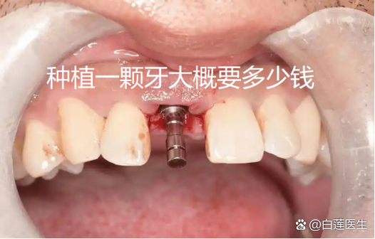 广州纯钛种牙多少钱一颗？费用明细和影响因素都在这里