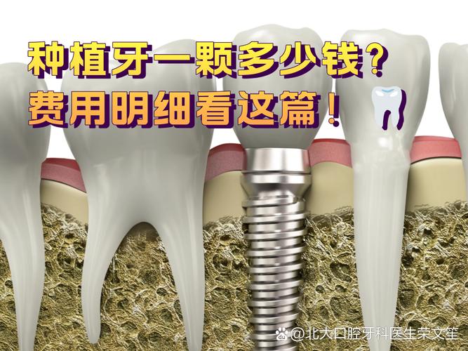 广州2025年种牙一颗到底要花多少钱？看完这篇不踩坑