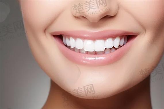 广州杭州自锁牙齿矫正多少钱？真实费用全揭秘