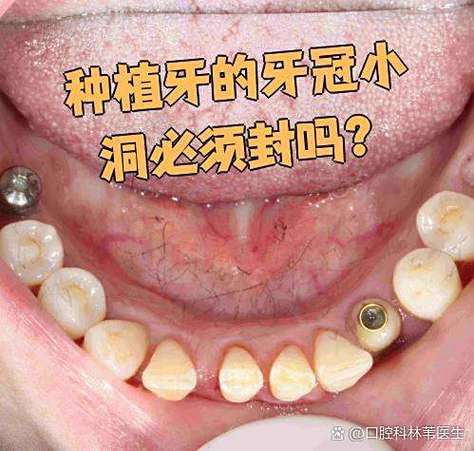 广州深圳龙华全口种牙当天戴牙冠靠谱吗