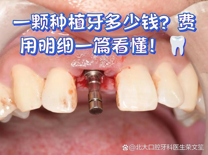 种牙修复到底值不值_种植牙修复必须去种的医院吗_种植牙失败了怎么办 修复费用