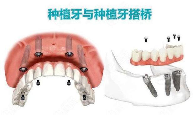 广州种植牙还是搭桥哪个更好