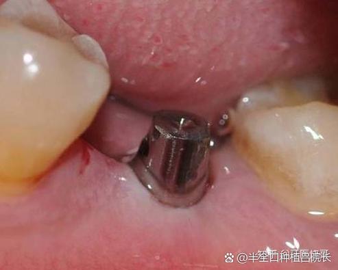 广州深圳瑞士ITI种植牙对牙槽骨要求高吗