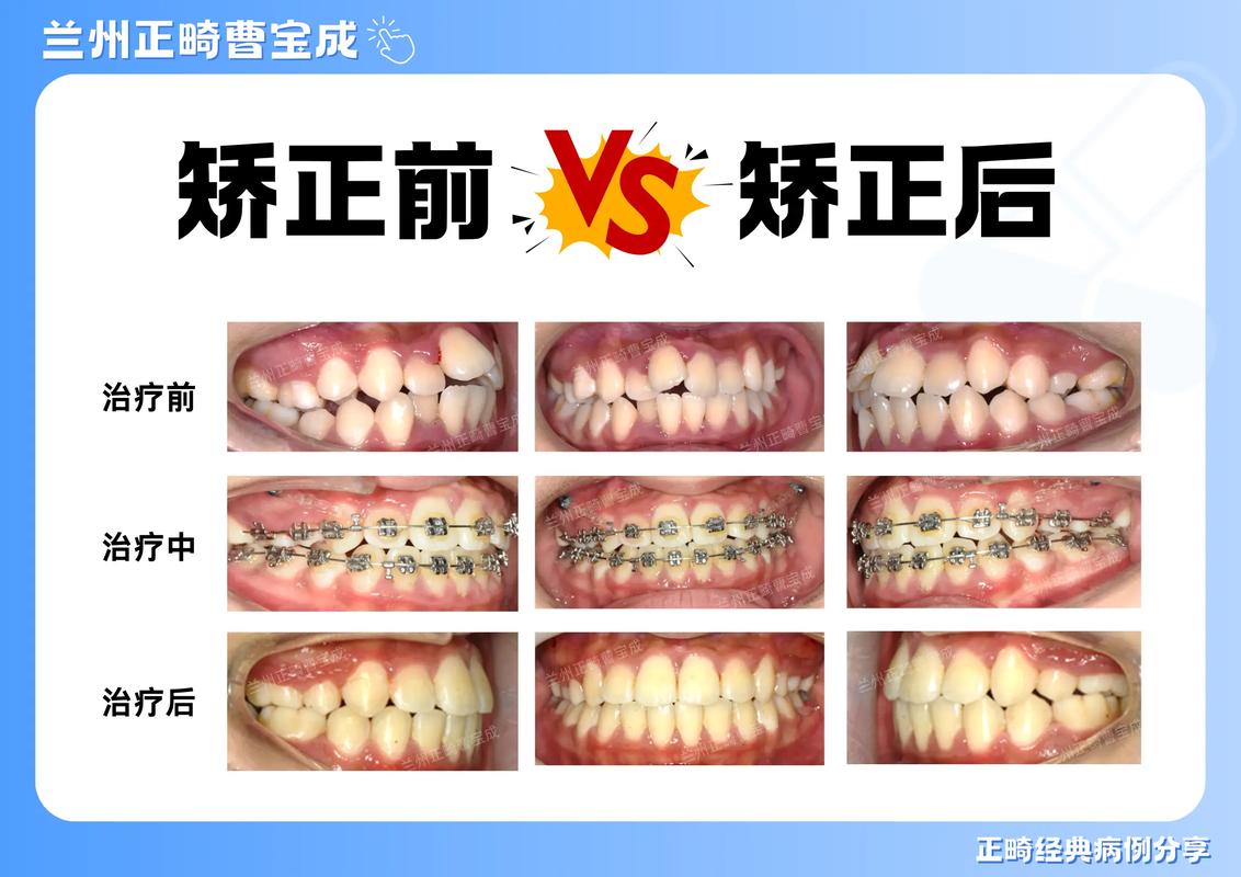 广州20岁矫正牙齿的利与弊 成年人整牙值不值