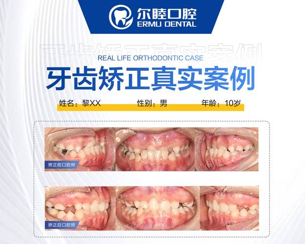 广州深圳龙华钢丝矫正哪里好？选对牙科很关键