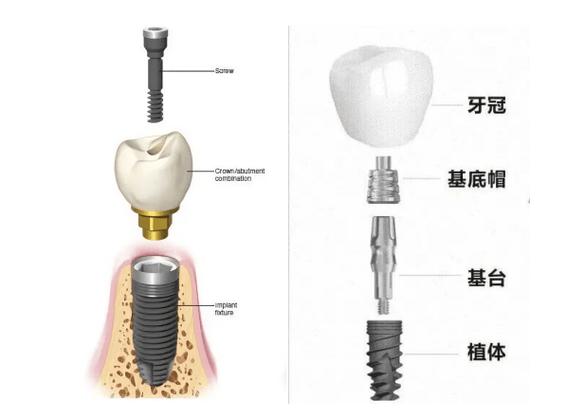 广州种牙全过程要多久？看完心里有数