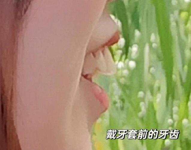 广州深圳骨性龅牙正畸选哪家医院？骨科正畸避坑全攻略