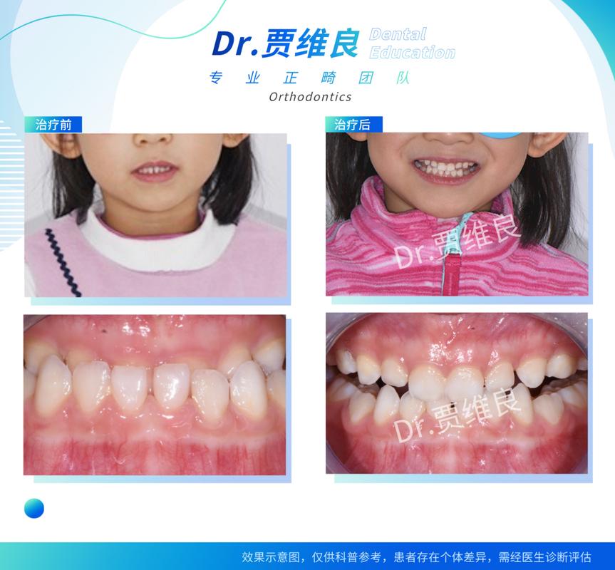 广州儿童牙齿校正几岁开始做合适？