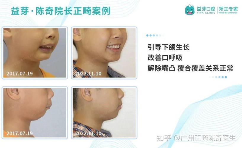 广州东莞儿童牙齿矫正几岁开始最好？家长别等换完牙才后悔