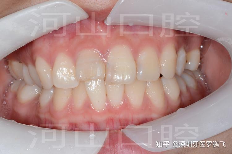 广州20岁牙齿还能不能矫正？成年人正畸真实情况揭秘