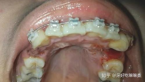广州宁波青少年牙齿矫正选哪家？费用多少？看完这篇就明白