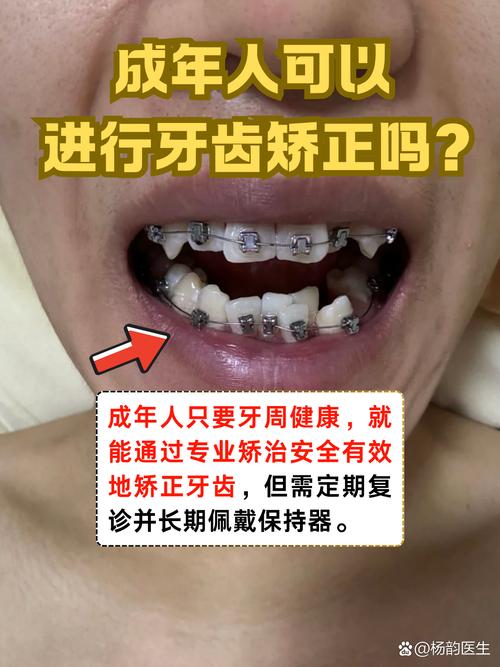 广州30岁矫正牙齿还来得及吗 成年人正畸必看