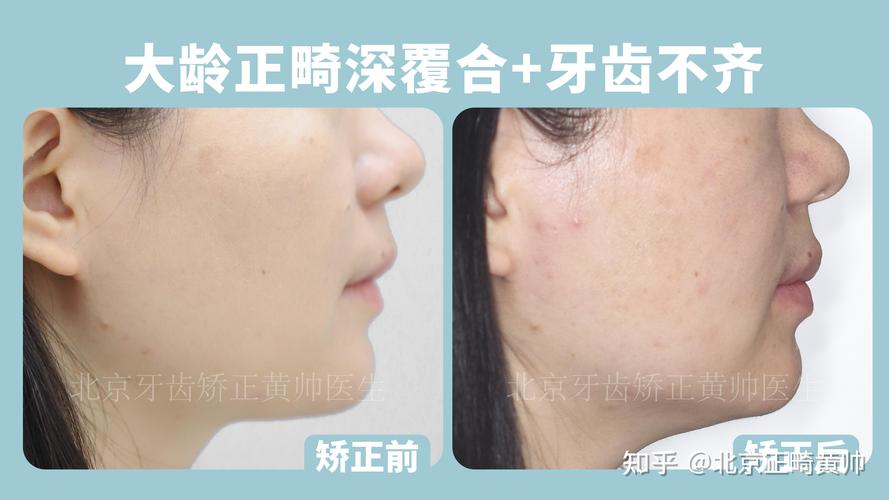 广州45岁做深覆合矫正大概多少钱？费用明细全公开