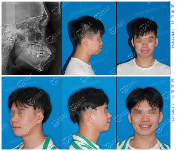 广州深圳罗湖骨性龅牙隐形矫正能行吗？方案详解