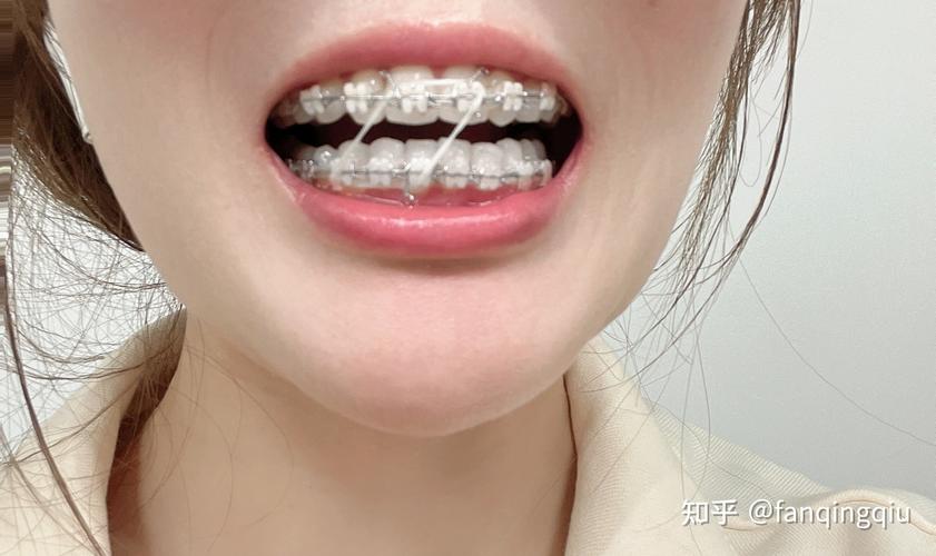广州27岁做牙齿矫正还来得及吗