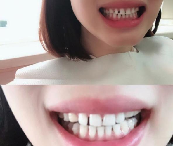 广州成都钢丝矫正牙齿要多少钱？真实价格全曝光