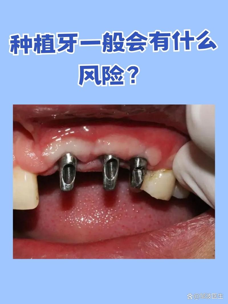 牙齿种植可以用医保吗_牙齿可以种植真的吗_牙齿种植可以用多久