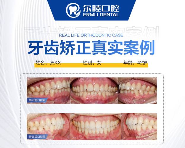 广州深圳牙缝过大矫正多少钱 2026最新报价参考