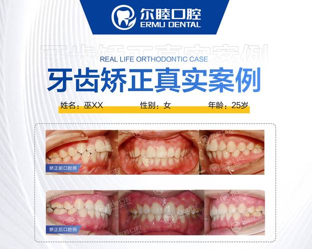 广州深圳宝安金属自锁托槽矫正哪里好?公立和私立医院怎么选