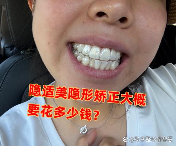 广州深圳龙岗隐适美牙套多少钱？收费明细看这篇