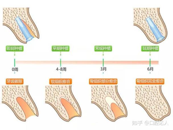 广州掉3颗牙怎样种植？种牙流程全解析+费用避坑指南