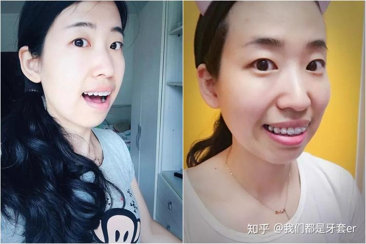 广州30岁做牙齿矫正晚不晚？真实情况告诉你