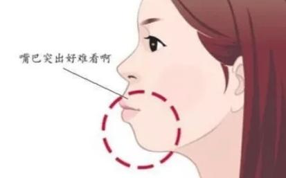 广州正颌手术前必读：矫正牙齿正颌全过程详解