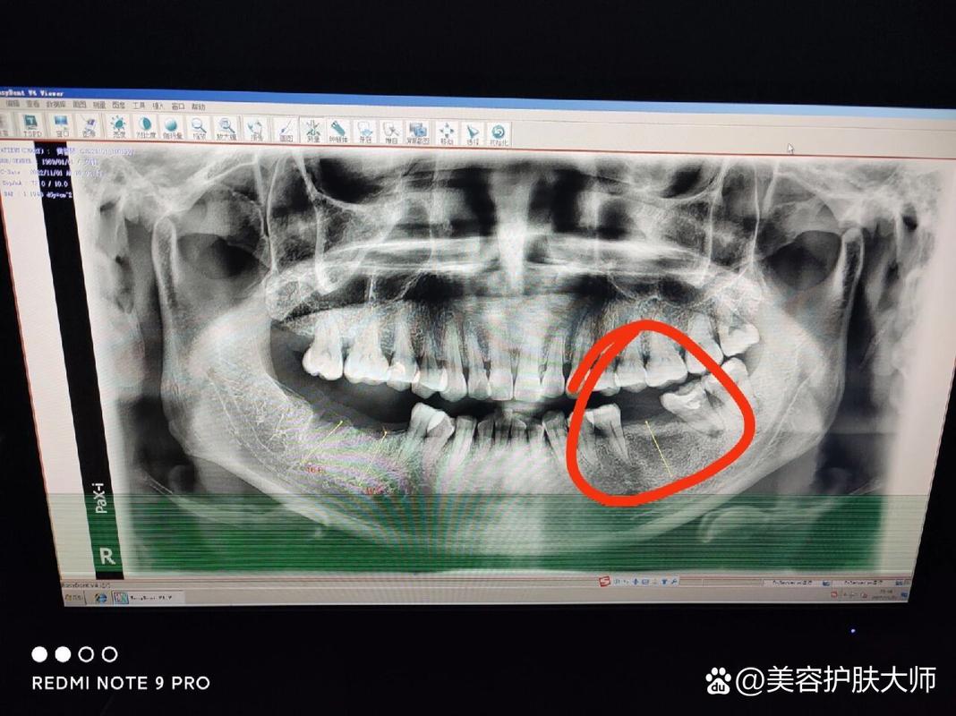广州深圳皓圣种植牙医院靠谱吗 真实推荐指南