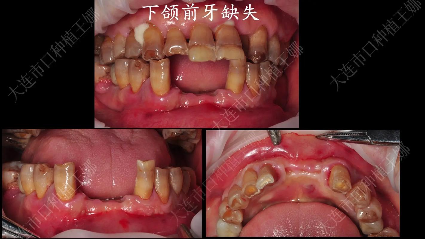广州拔前牙能整好牙吗？真相与风险全解析