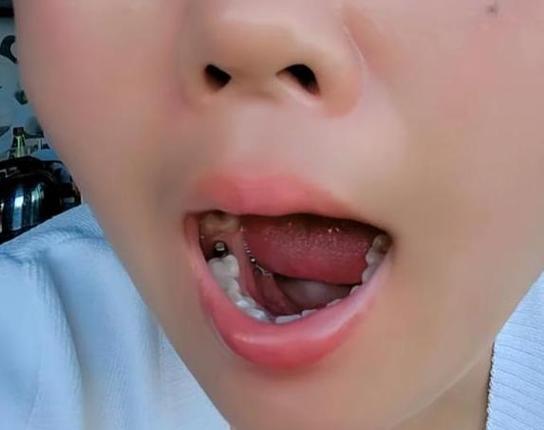 广州55岁种牙好还是镶牙好？一文告诉你答案