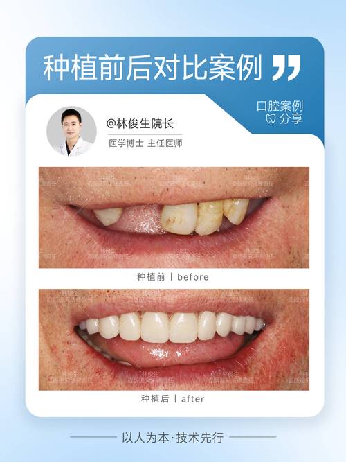 广州罗湖东门种牙多少钱 2026最新价目表