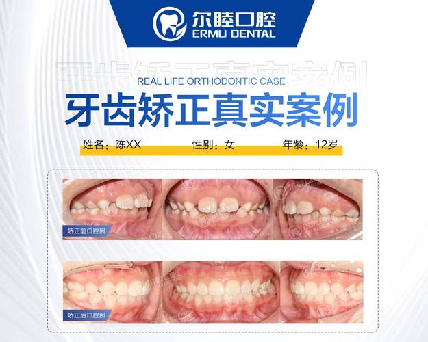 广州深圳西乡牙齿矫正费用到底要多少钱？2026年最新价格参考