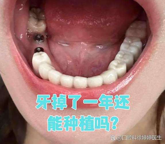 现在牙齿掉了可以种植吗_做了一颗种植牙还可以_牙齿种植掉现在可以种植吗