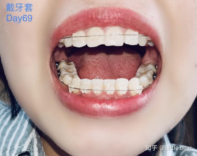 牙齿矫正能走医保吗_24岁能牙齿矫正吗_牙齿矫正能只矫正上面吗