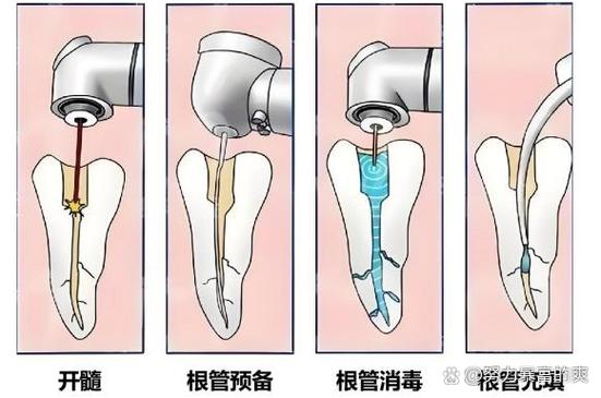 广州种牙要等多久 最佳种牙时间全知道