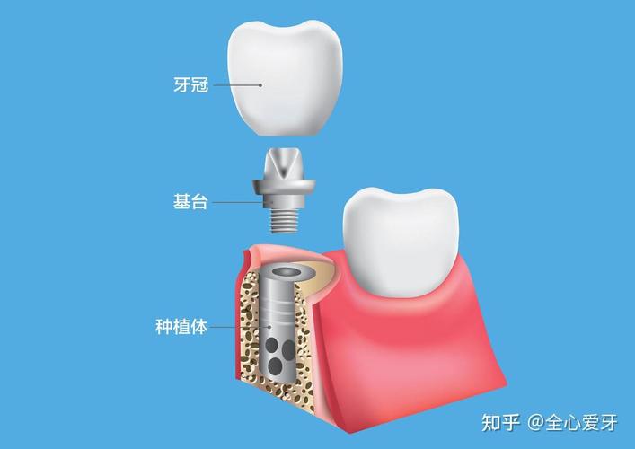 广州佛山种植牙集采后4500元全包靠谱吗 2026最新解读