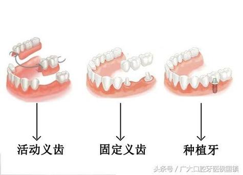 广州儿童乳牙缺失别着急 种植牙修复方案全解
