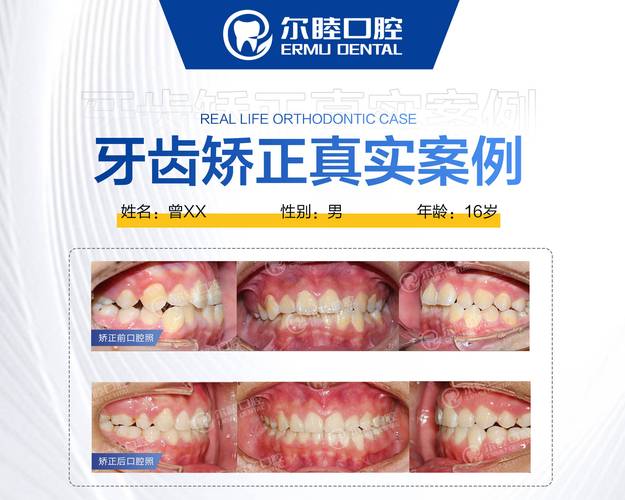 广州深圳儿童牙齿矫正多少钱？不同套餐收费全解析
