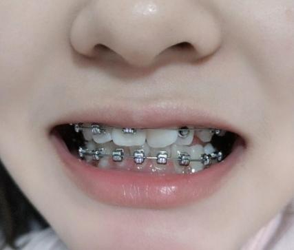 广州30岁做牙齿矫正有什么后遗症？看完这篇不踩坑