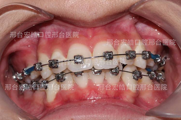 广州不整齐牙齿矫正到底要花多少钱？大概多久能好？