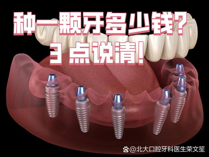 广州沈阳种牙2026年单颗多少钱?3000到5200元能搞定吗