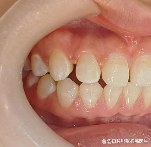 牙科矫正牙缝大手术视频_矫正报价深圳牙缝过大的医院_深圳牙缝过大矫正报价
