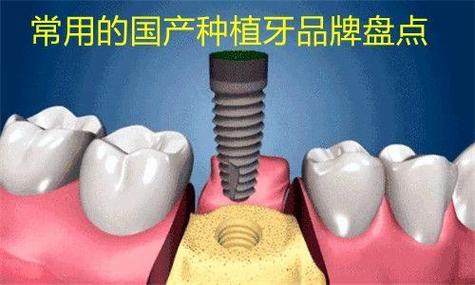 广州潍坊国产种植牙百康特多少钱一颗？