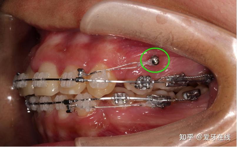 广州20多岁矫正牙齿会后悔吗？医生说大实话